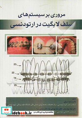 مروری بر سیستم های سلف لایگیت در ارتودنسی