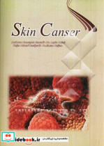 Skin cancer